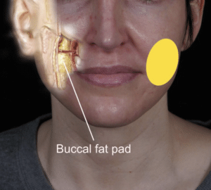 buccal fat anatomy; buccal fat removal regret